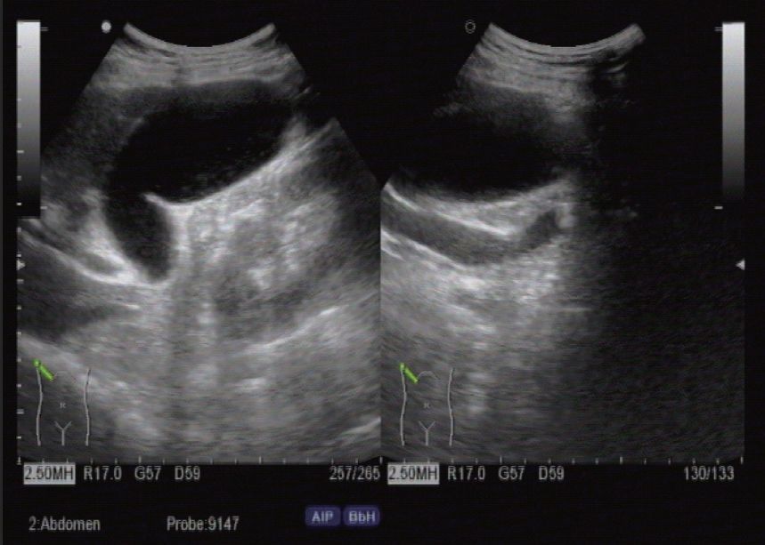 胆囊超声需要空腹吗,胆囊超声检查多少钱