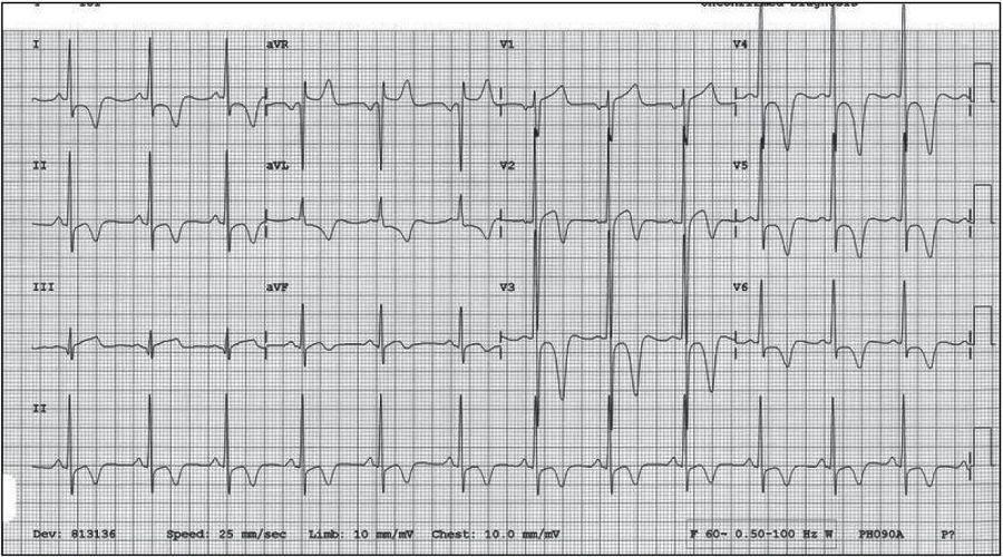 心尖部肥厚型心肌病心电图表现,心尖肥厚型心肌病心电图