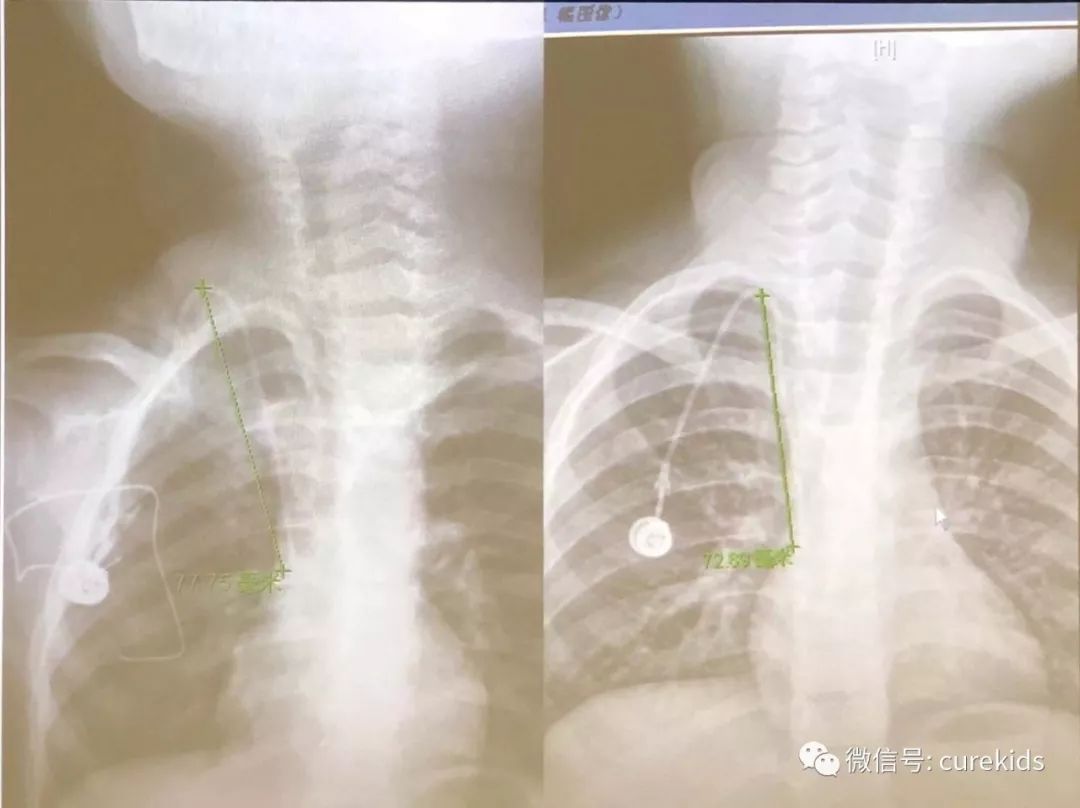 结疗后半年可拆除输液港，置留期该如何护理？蔡瑞卿老师告诉你答案｜向日葵问答