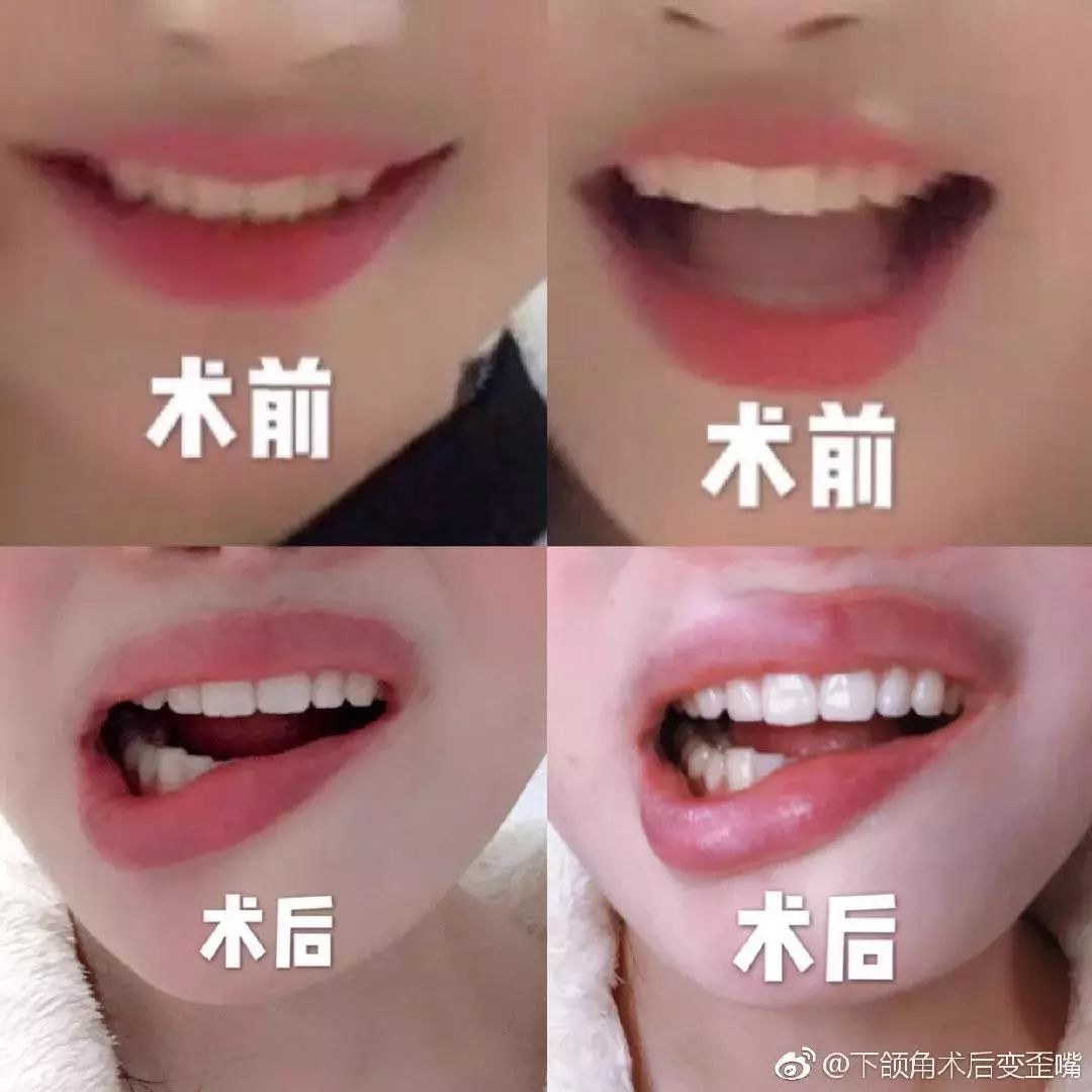 女子整容嘴变歪后来怎么样了,女子整容导致嘴歪眼斜