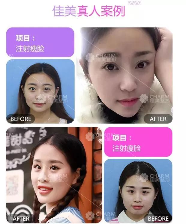女子整容嘴变歪后来怎么样了,女子整容导致嘴歪眼斜