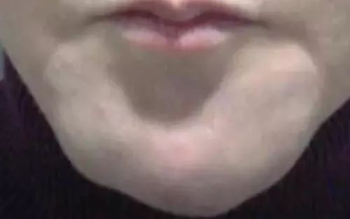 注射生长因子填充脸部7年,生长因子除皱打了一次有危害吗