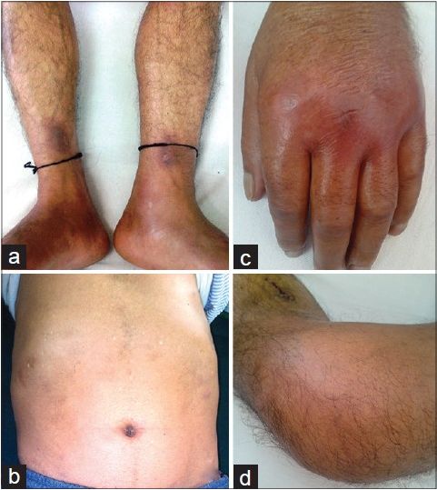 重症脂源性胰腺炎,炎症性胰腺炎