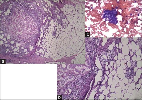重症脂源性胰腺炎,炎症性胰腺炎