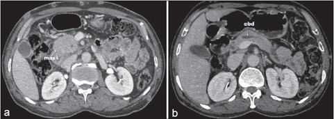 重症脂源性胰腺炎,炎症性胰腺炎