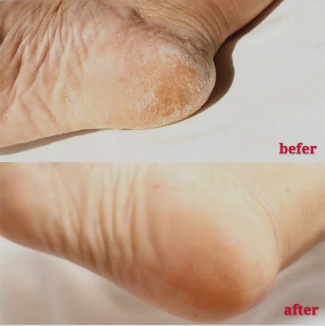 每天成交2w单！连穿7天不臭脚的袜子，世界专利金奖，连脚气都没复发了！