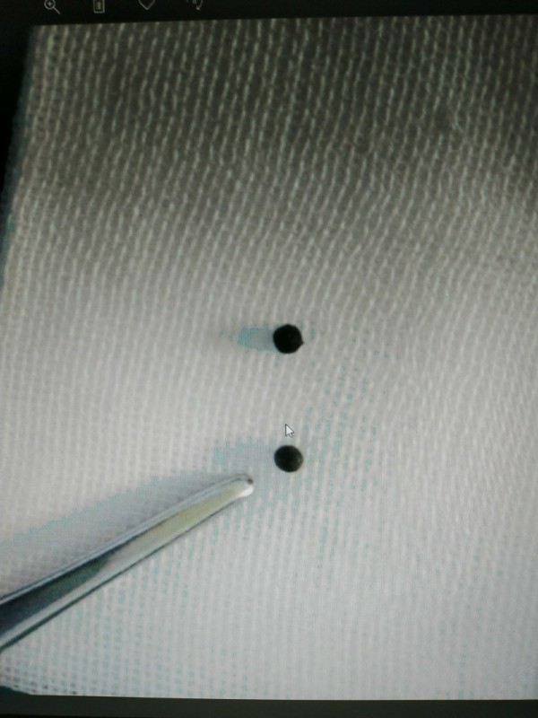 十三岁男孩被火炮爆伤,小孩被枪打中后脑