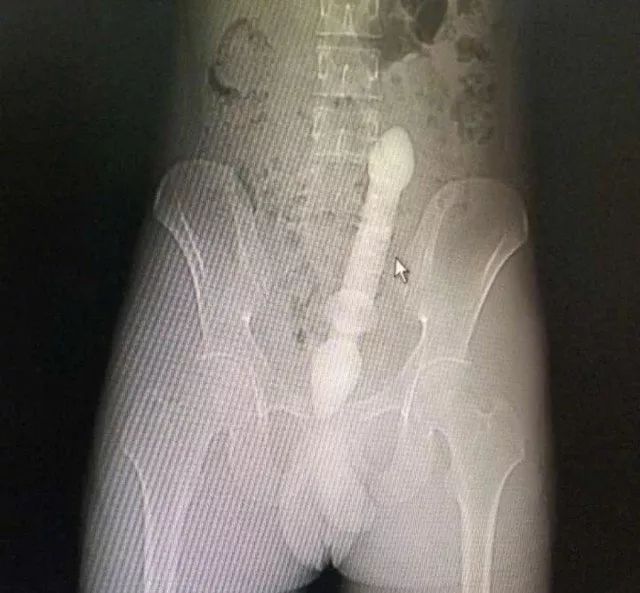 男子肛门塞进三条泥鳅，知道原因医生要哭了…