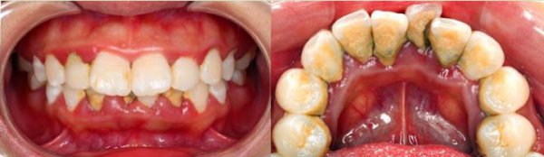 牙齿有烟渍和牙结石,不认真刷牙会长牙结石