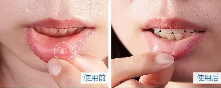 央视都推荐的新西兰国宝，1秒润喉，不咳嗽，口腔问题都好啦