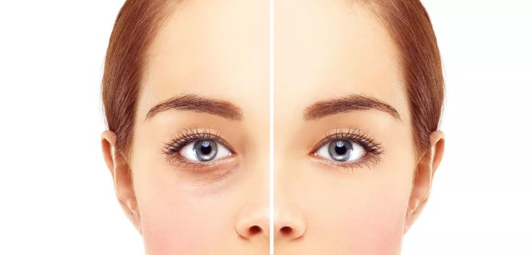 当心你的黑眼圈类型,黑眼圈长久不消是怎么回事