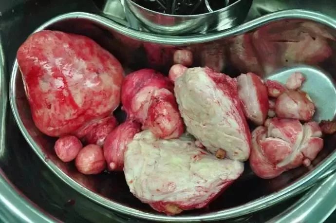 被“它”折磨的女性越来越多！医生看到她子宫里的东西——彻底惊呆了！