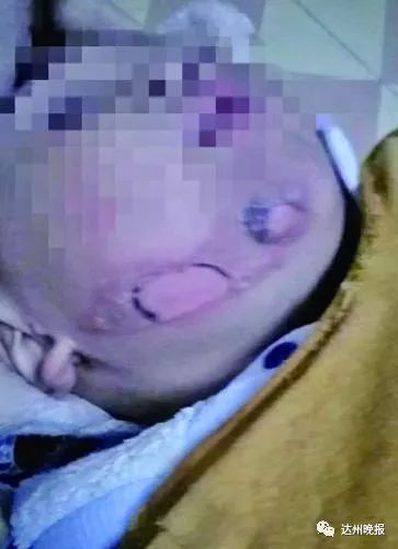 3岁小孩被烫伤交警15分钟紧急送医,1岁幼童被2000度热水烫伤