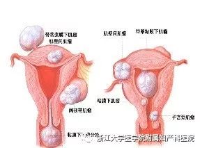 子宫肌瘤有什么症状是癌变了,子宫肌瘤是不是癌