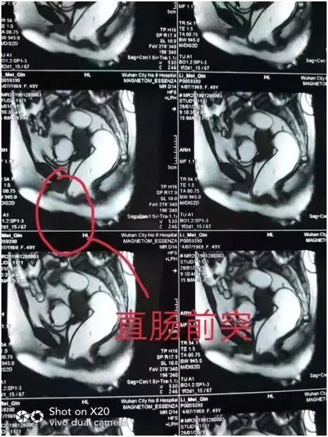 梗阻性便秘手术管用吗,老人出口梗阻型便秘手术方式