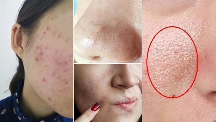 脸上螨虫黑头用完除螨皂好了,脸上有螨虫防螨皂