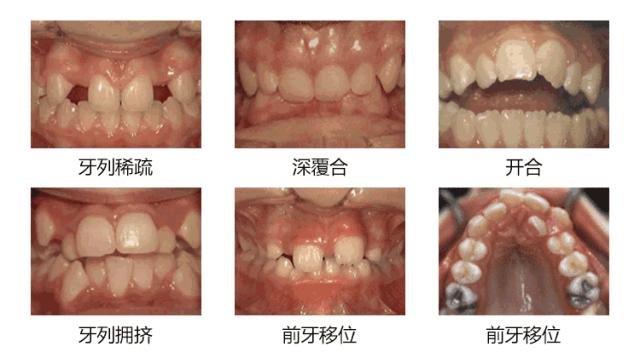 牙齿矫正新措施落地福州,福州牙齿矫正免费领取