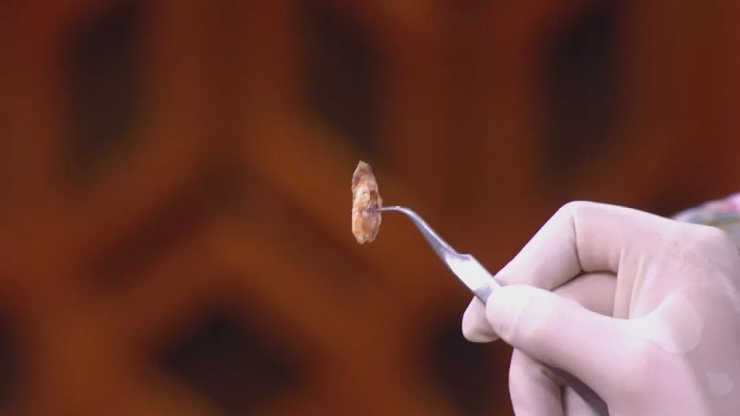 北京卫视养生堂治脑梗食疗,预防脑梗养生堂