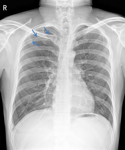 气胸的x线表现胸膜炎,胸外科气胸病人病例
