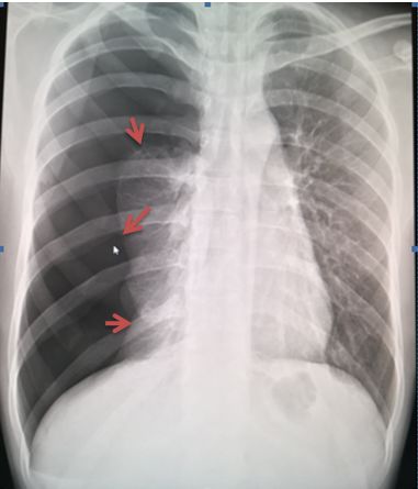 气胸的x线表现胸膜炎,胸外科气胸病人病例