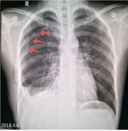 气胸的x线表现胸膜炎,胸外科气胸病人病例