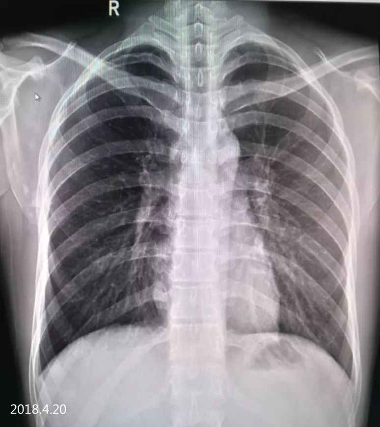 气胸的x线表现胸膜炎,胸外科气胸病人病例