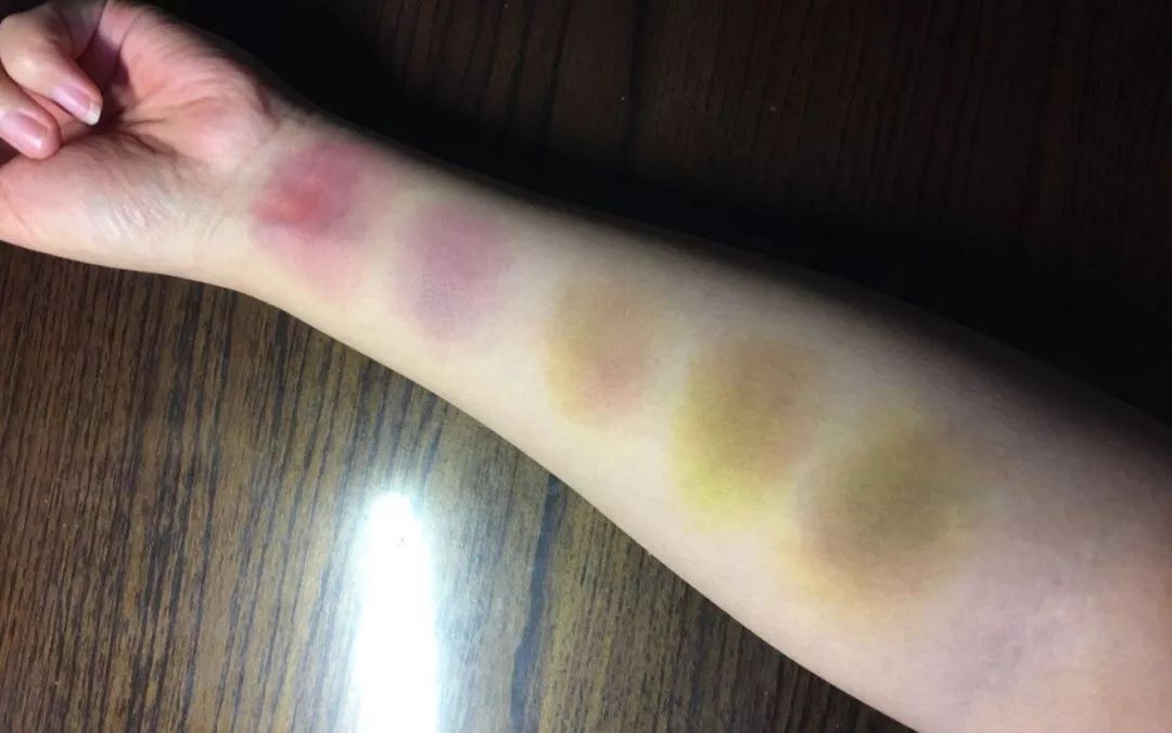 身体莫名出现淤青是癌症前兆吗,身体莫名其妙出现淤青是癌症吗