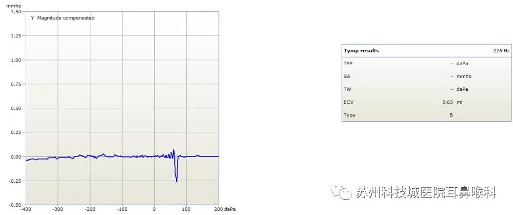 声导抗检测报告怎么看,声导抗测试报告中mep多少正常