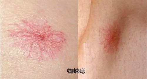 红色痣肝癌的前兆,身上红色的小血点像痣是不是肝癌