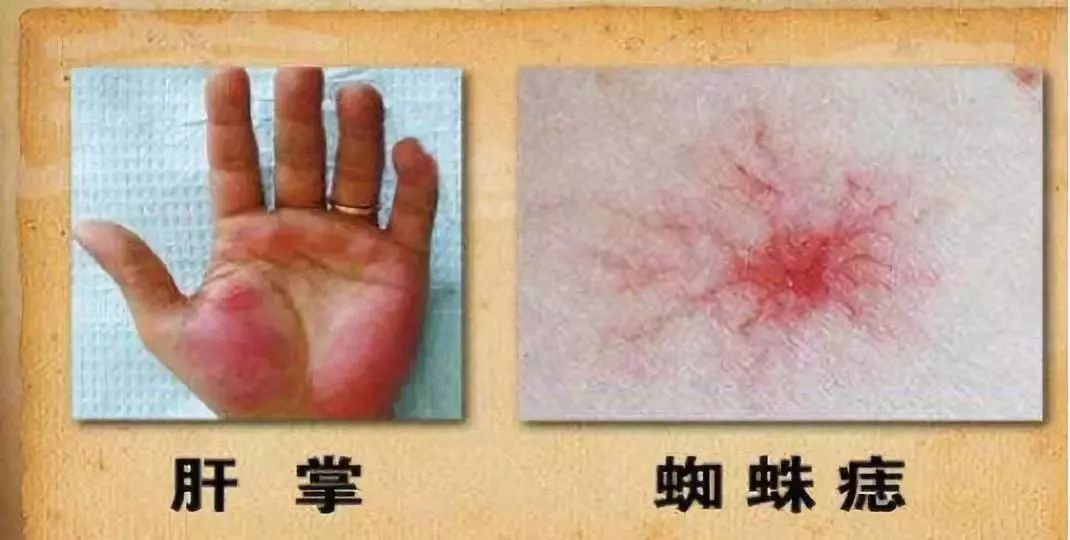 红色痣肝癌的前兆,身上红色的小血点像痣是不是肝癌