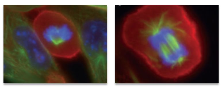 中国肿瘤电场治疗真实情况,肿瘤电场治疗为何不推广