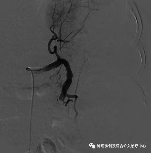 脾动脉栓塞术,脾栓塞手术的适应症