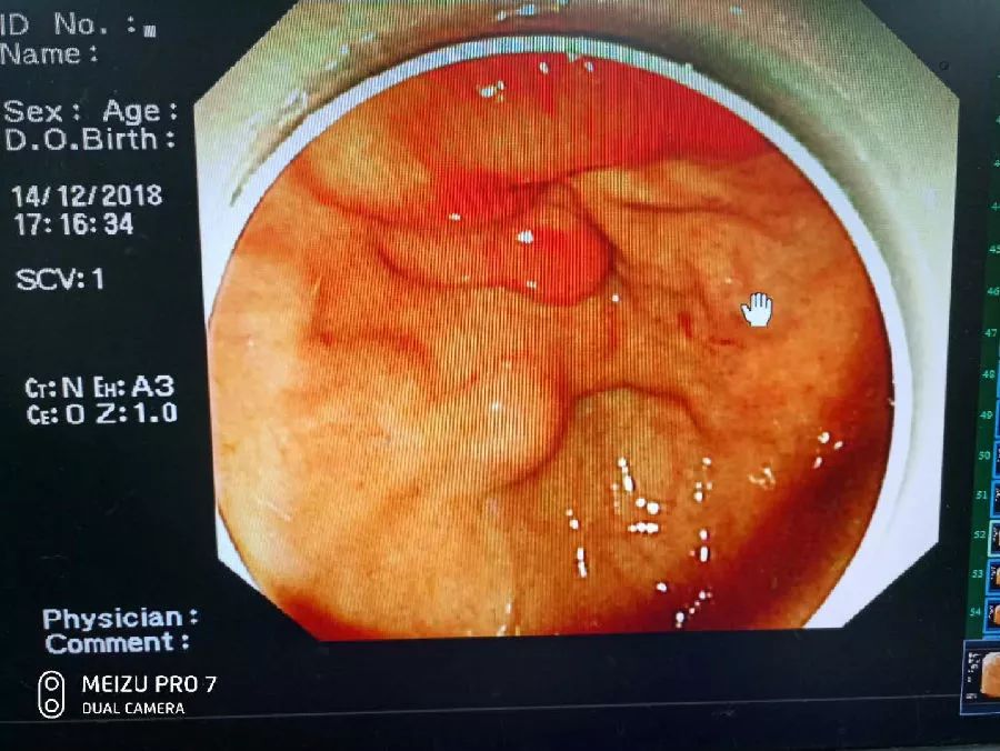 肝硬化食管胃底静脉曲张破裂出血,胃底静脉曲张破裂出血病历