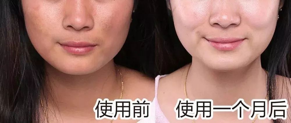 美白针可以10天打一次吗,可以美白的针