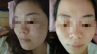 美白针可以10天打一次吗,可以美白的针