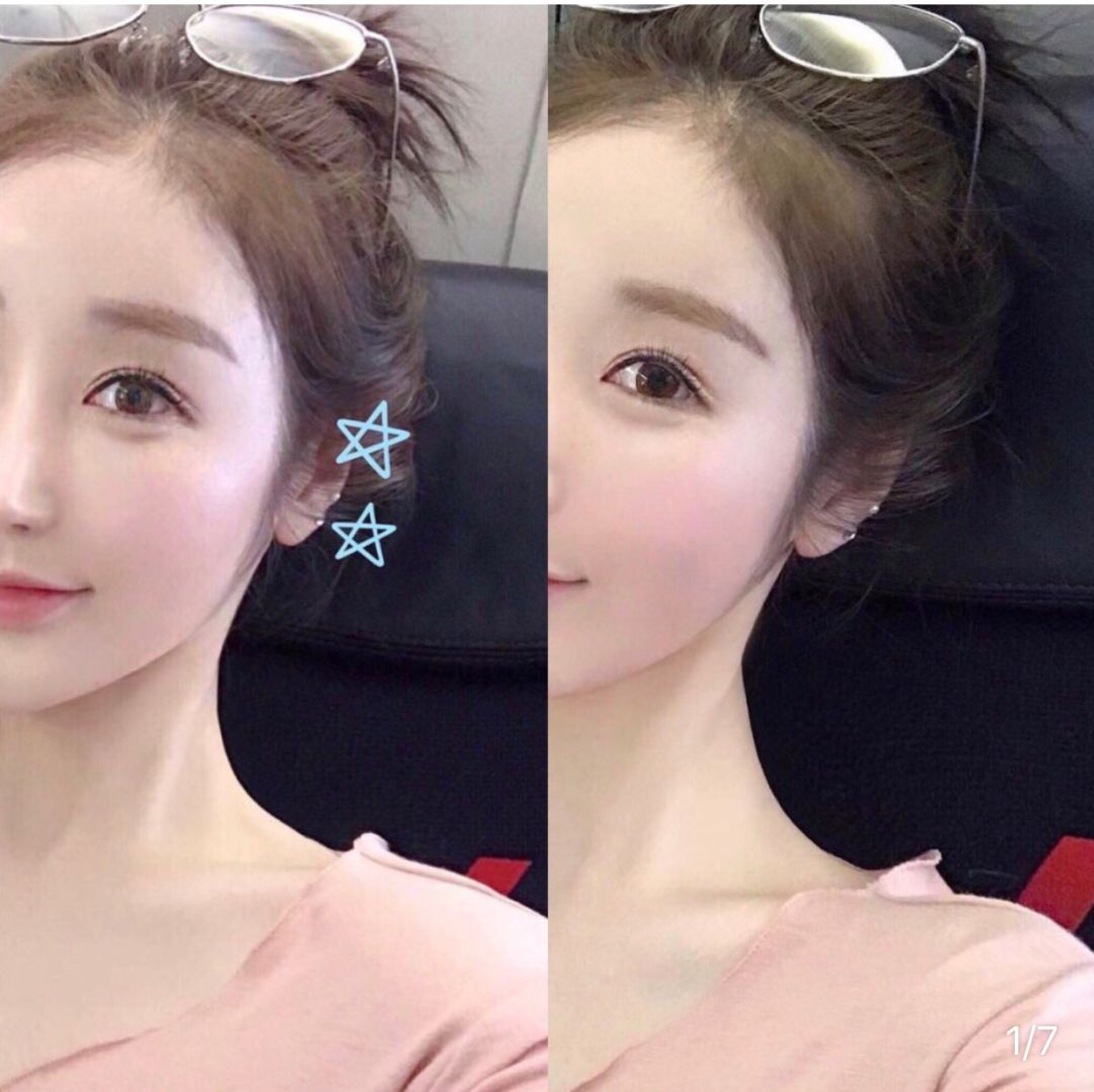 美白针可以10天打一次吗,可以美白的针