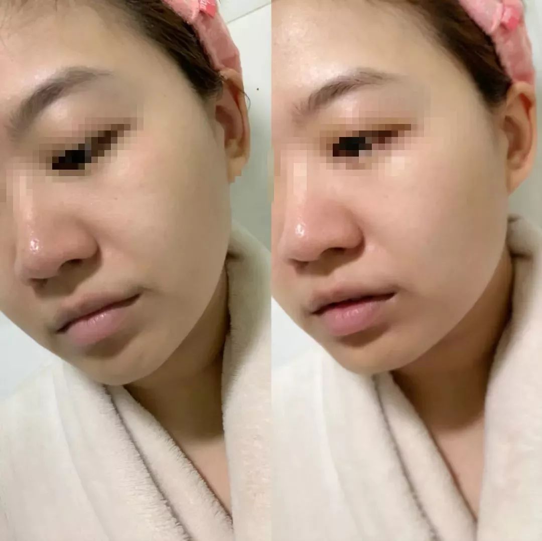 美白针可以10天打一次吗,可以美白的针