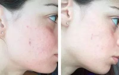 美白针可以10天打一次吗,可以美白的针