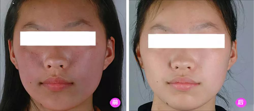 美白针可以10天打一次吗,可以美白的针