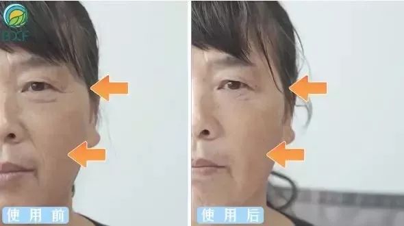 6d线雕提拉童颜术,不打针不开刀祛皱纹的轻医美