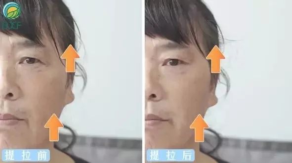 6d线雕提拉童颜术,不打针不开刀祛皱纹的轻医美