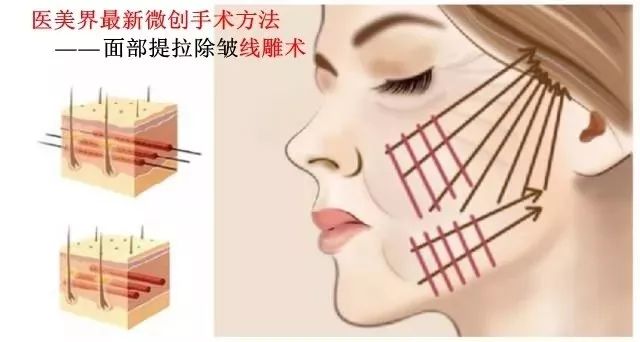 6d线雕提拉童颜术,不打针不开刀祛皱纹的轻医美