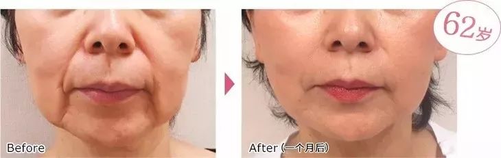 6d线雕提拉童颜术,不打针不开刀祛皱纹的轻医美