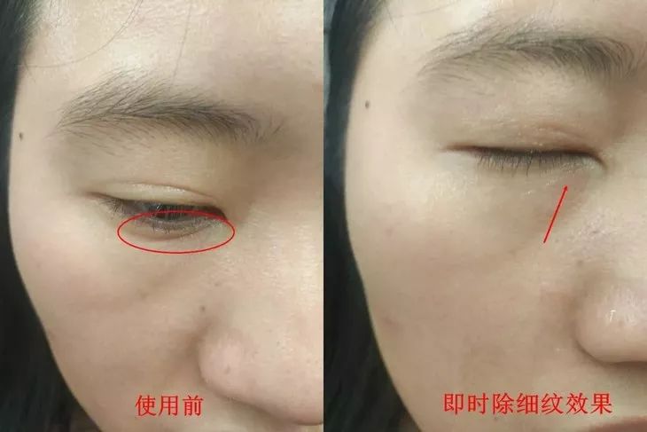 6d线雕提拉童颜术,不打针不开刀祛皱纹的轻医美