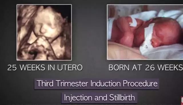 多次打胎真实案例,25岁女生接受多少次打胎