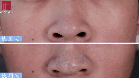 拨黑头工具草莓鼻,去黑头神器真的能吸出黑头