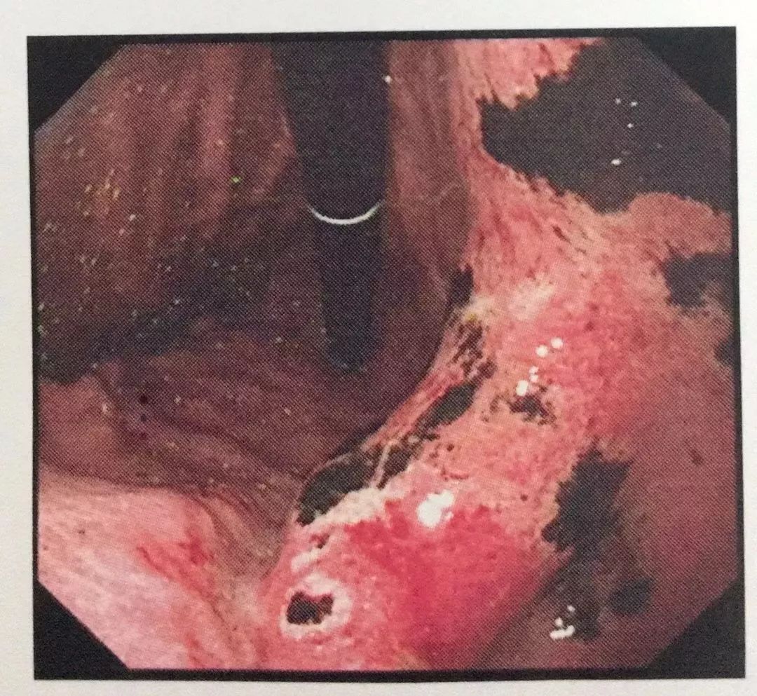 吃一次等于喝3次马桶水！这个食物让小伙整个胃烂了…