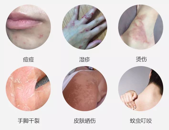 蚊虫叮咬湿疹止痒哪种药膏好用,晒伤后两天奇痒止痒最佳办法