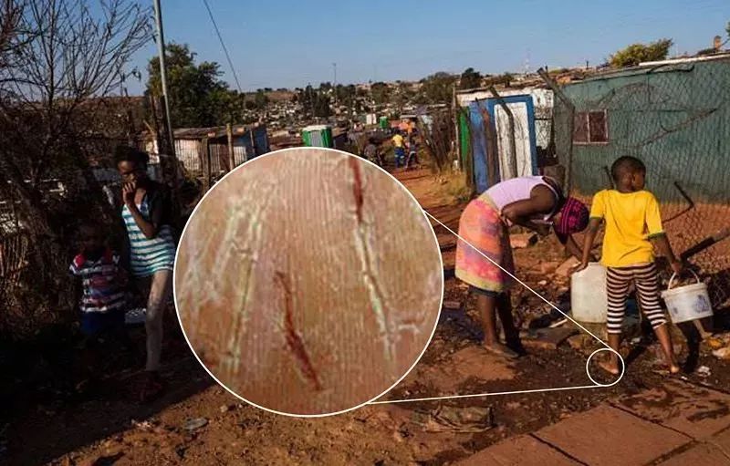 蚊虫叮咬湿疹止痒哪种药膏好用,晒伤后两天奇痒止痒最佳办法