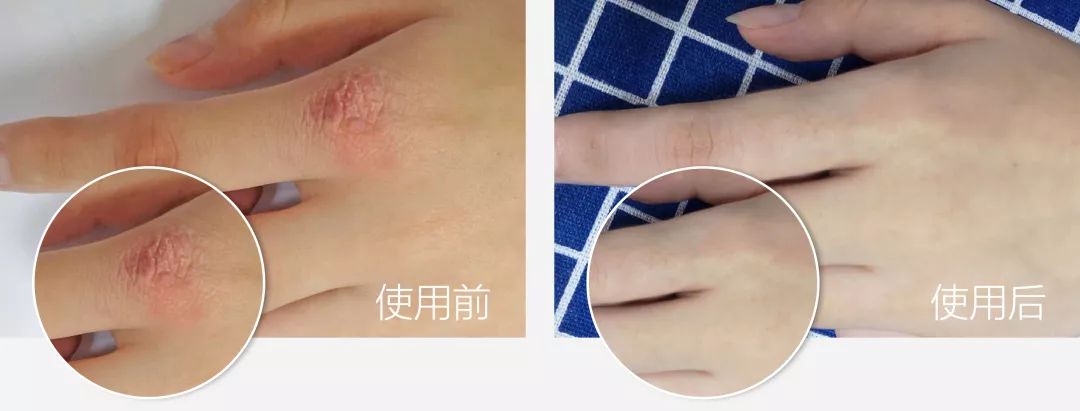 蚊虫叮咬湿疹止痒哪种药膏好用,晒伤后两天奇痒止痒最佳办法